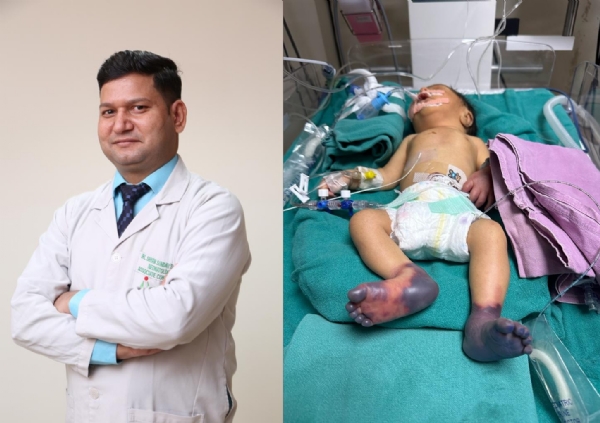 जानलेवा गैंग्रीन से पीड़ित समय से पहले जन्मे नवजात का चिकित्सकों ने किया इलाज